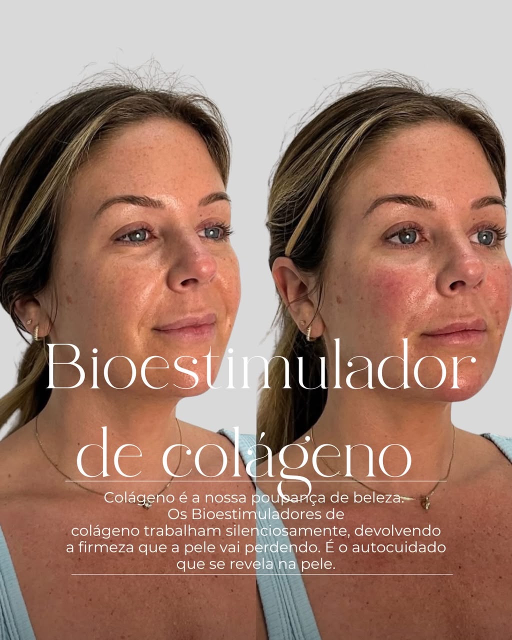 Bioestimulador de colágeno