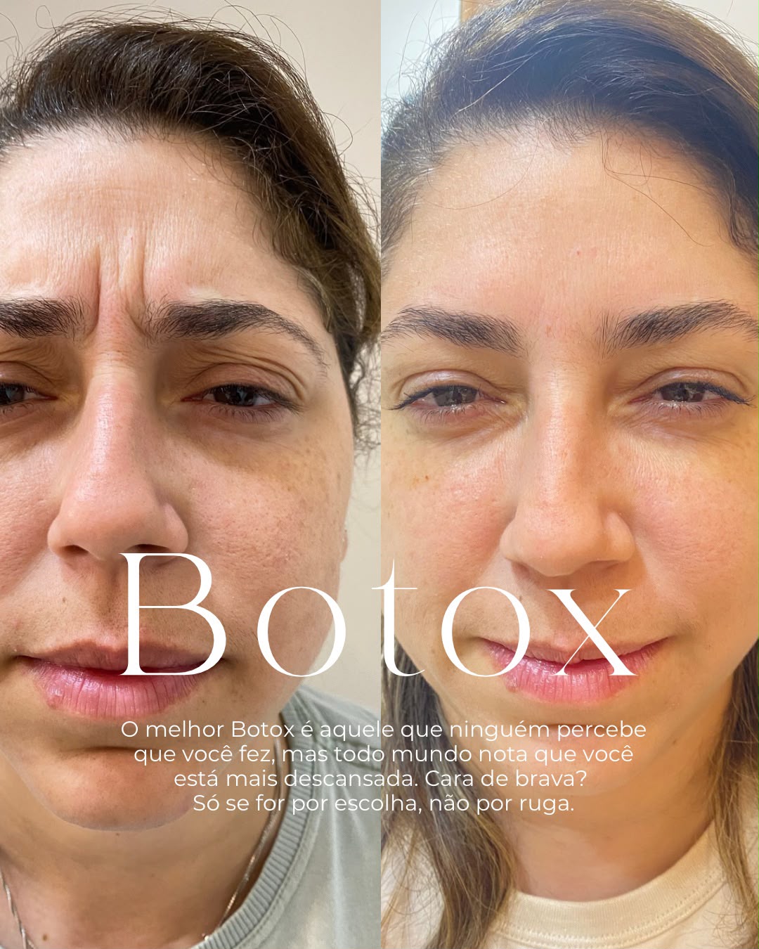 Resultado Botox testa