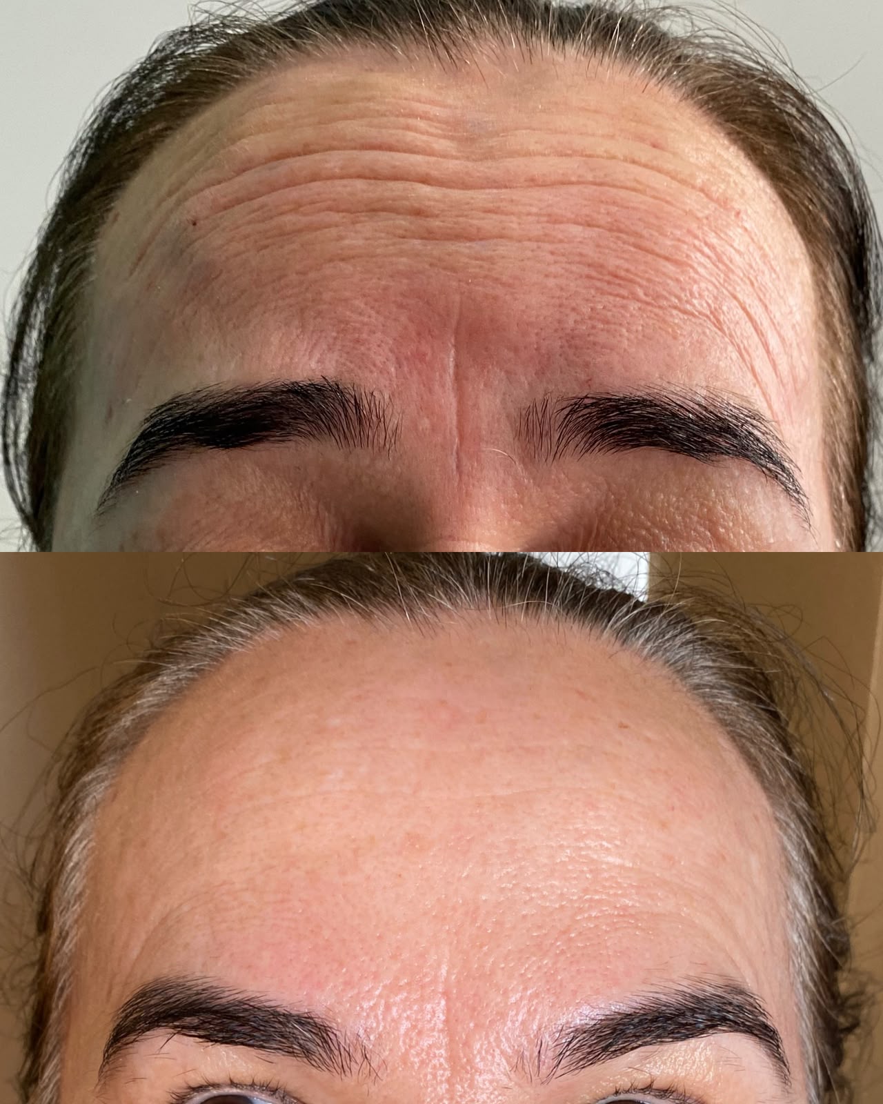Botox / Toxina botulínica