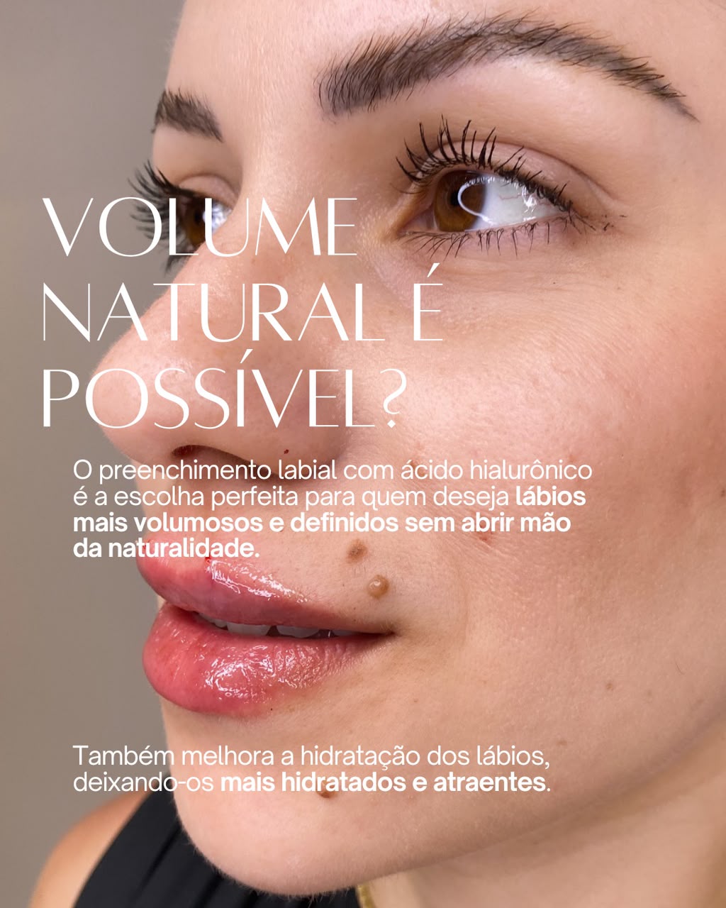 Resultado preenchimento labial