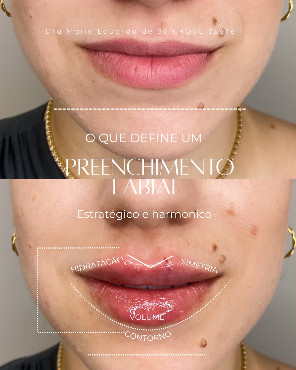 Resultado preenchimento labial