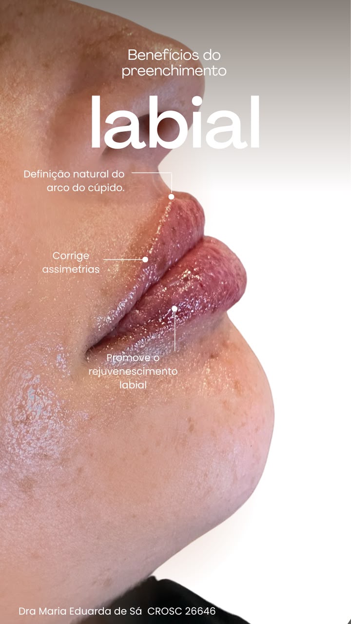 Preenchimento labial